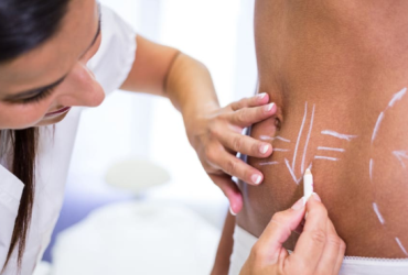 Lipoaspiração x hidrolipo: quais as diferenças entre os procedimentos?
