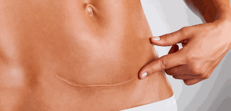Cirurgia de correção de cicatriz de cesárea