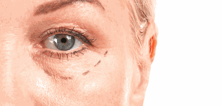 Blefaroplastia: entenda como funciona o pós-operatório